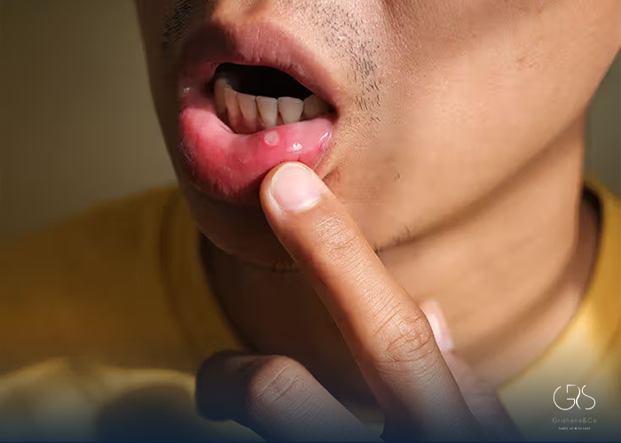 Complications Associated with Canker Sores