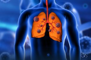 Causes of Lung Cancer: Unveiling the Key Factors