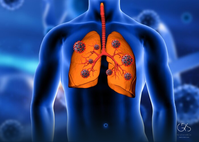 Causes of Lung Cancer