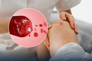 Excessive Bleeding: Understanding Hemorrhage