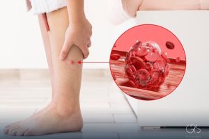High Cholesterol Symptoms: Effects on Feet and Legs