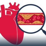 LDL Cholesterol: A Comprehensive Guide