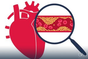 LDL Cholesterol: A Comprehensive Guide