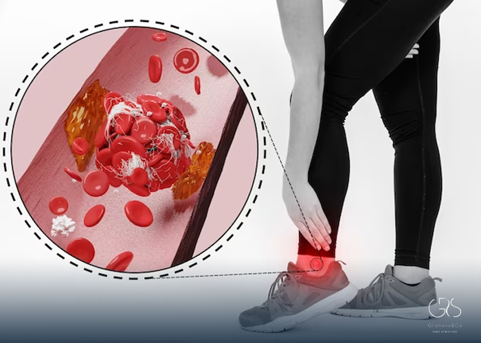 Diabetic Foot Complications and High Cholesterol