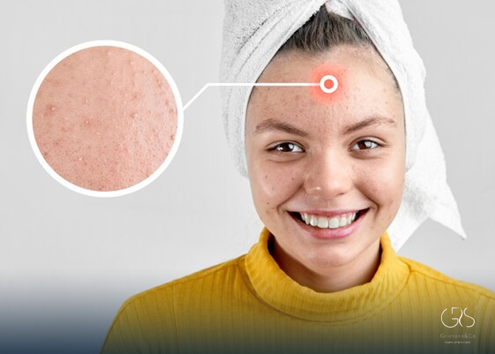 Reduction of Acne Scars and Hyperpigmentation