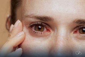 Pink Eye Treatments: A Comprehensive Guide