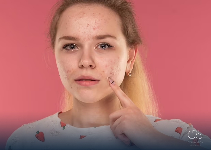 Understanding Sebum: Managing Oily Skin and Acne