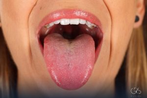 Tongue Burns: Quick Relief Tips