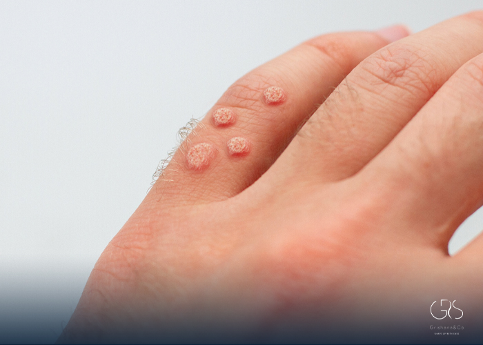 Wart Removal: A Complete Guide