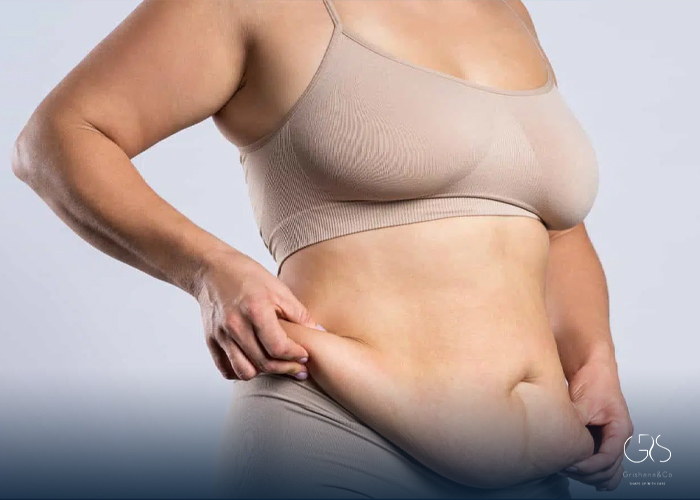 What Causes Excess Skin After Weight Loss?