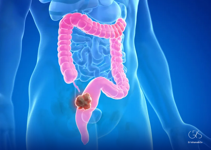 Understanding Colorectal Cancer: A Comprehensive Guide