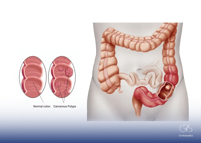 What is Colorectal Cancer?