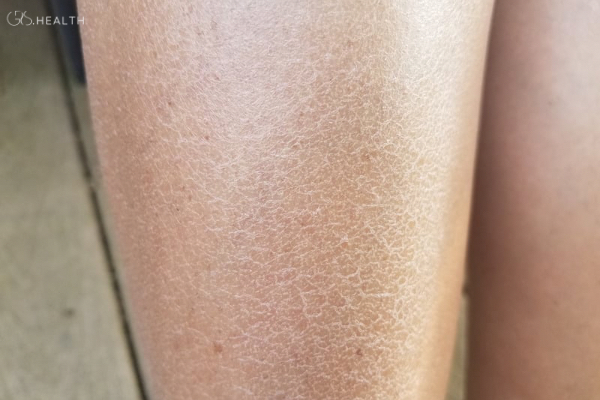 Dry Skin & Environmental Factors