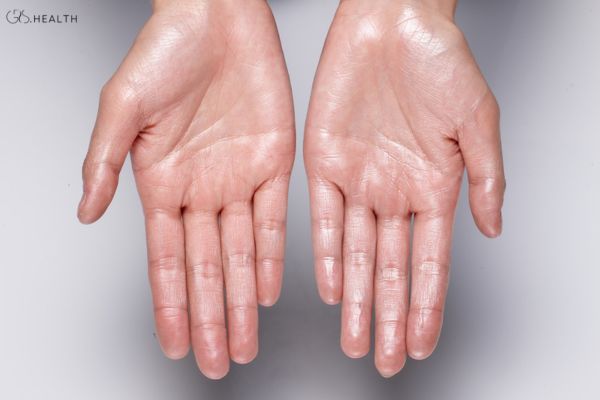 palmar hyperhidrosis treatment