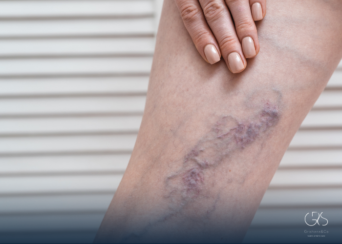 Understanding Blood Clots (Thrombosis Basics)