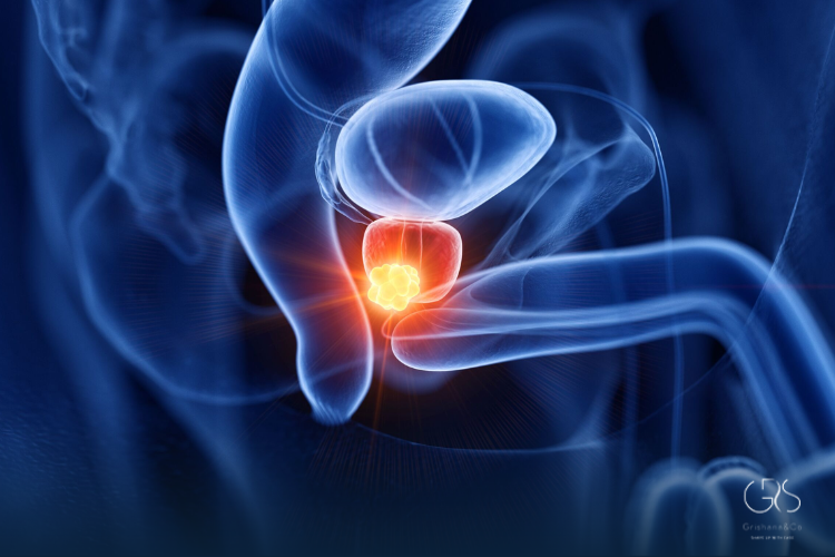 Prostate Cancer Stages Explained Clearly