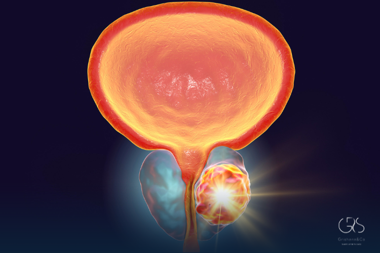 Stage I Prostate Cancer Explained