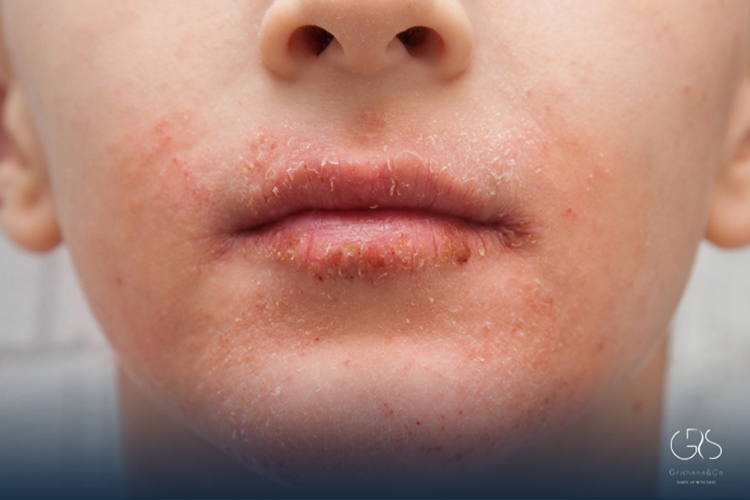 Child Mouth Rash: Is It a Food Allergy or Something Else?